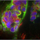 Noncancerous cells carry weight
