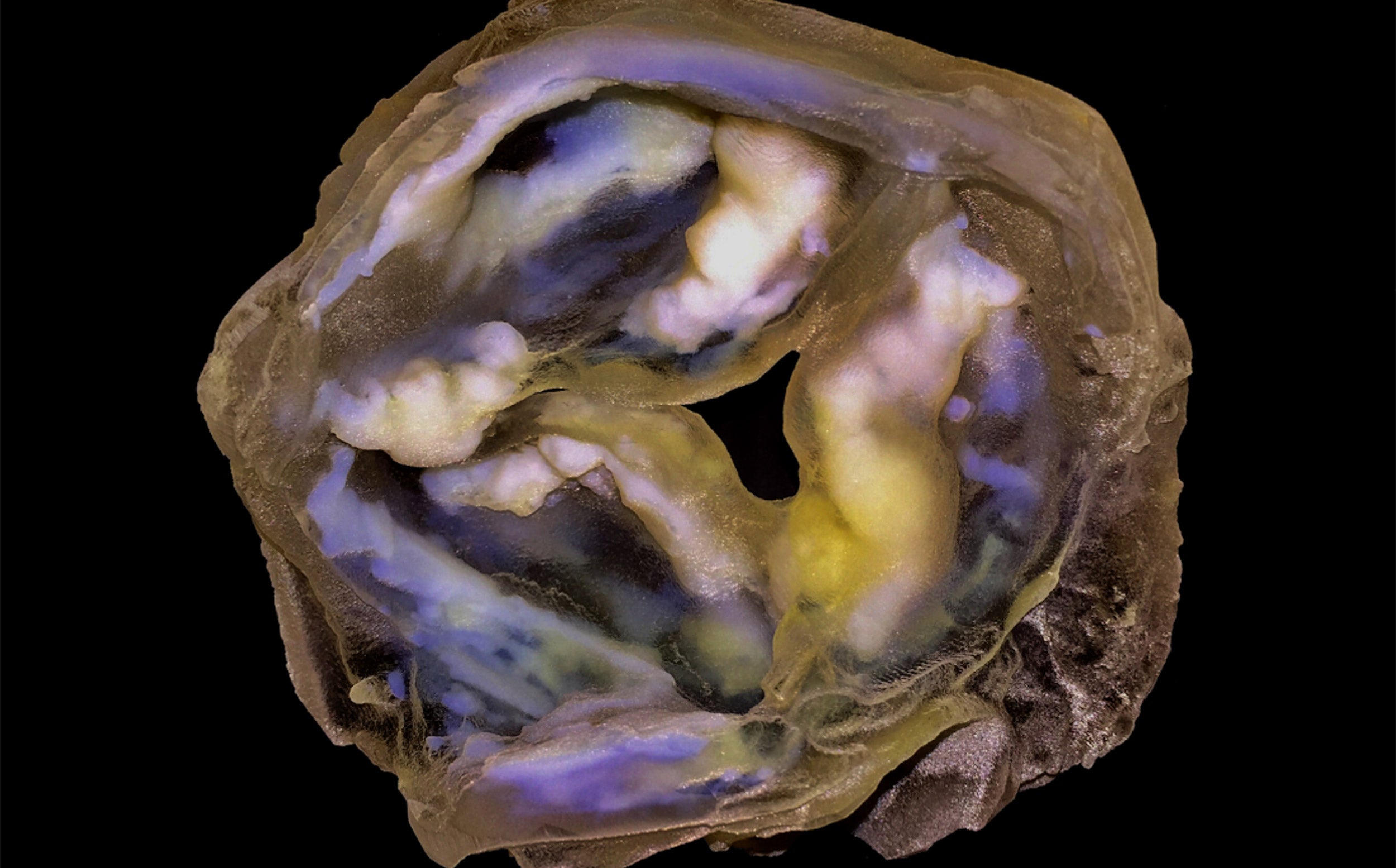 calcified heart valve