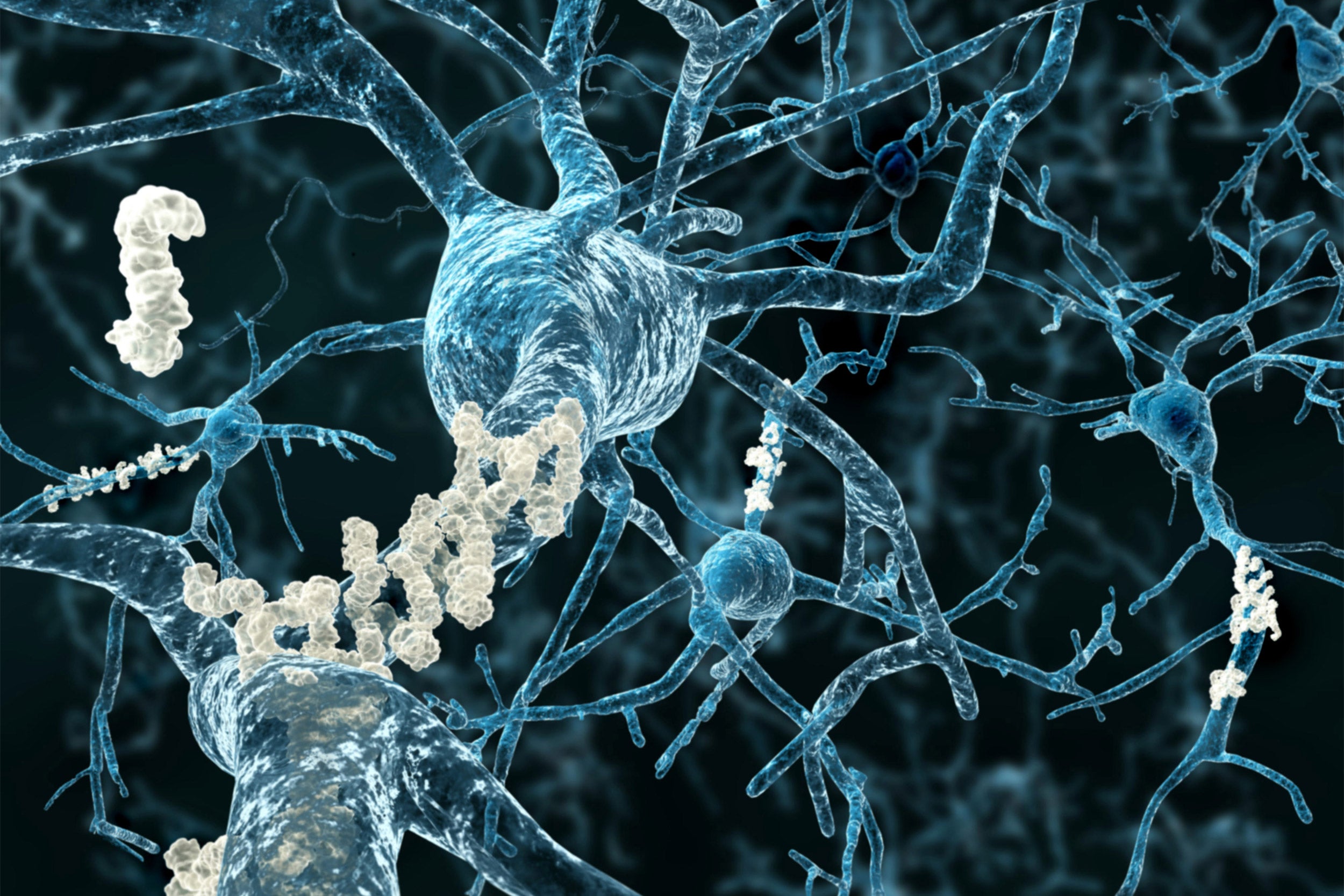 Amyloid plaques on axons of neurons affected by Alzheimer's