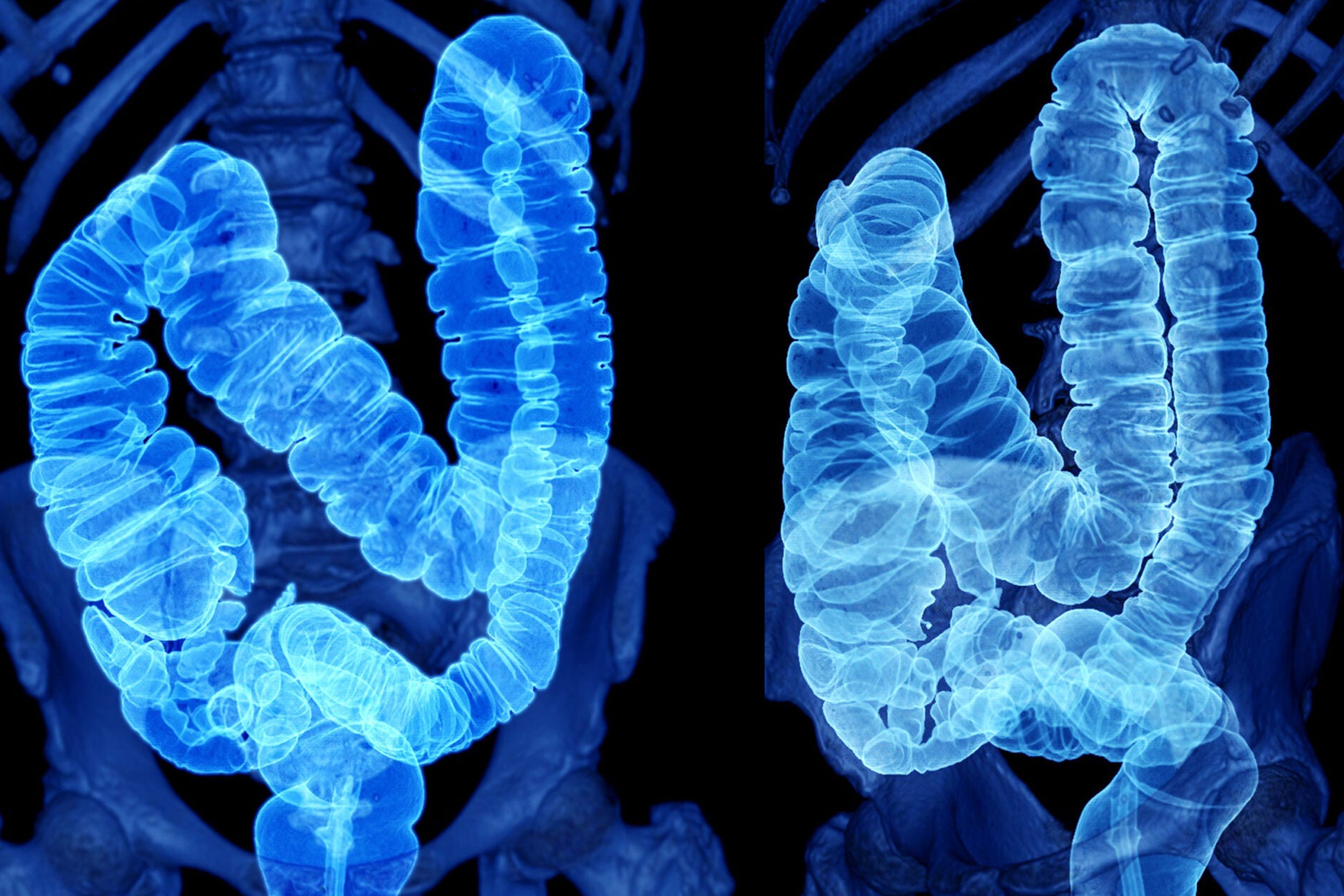CT Scan of Colon 3D Rendering image.