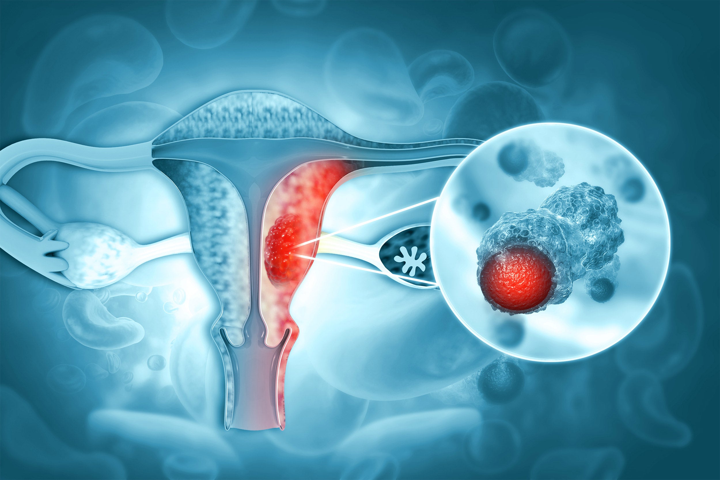 Endometrial cancer Information