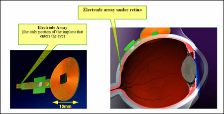 close-up of electrode array, cross-section of eye with electrode array in