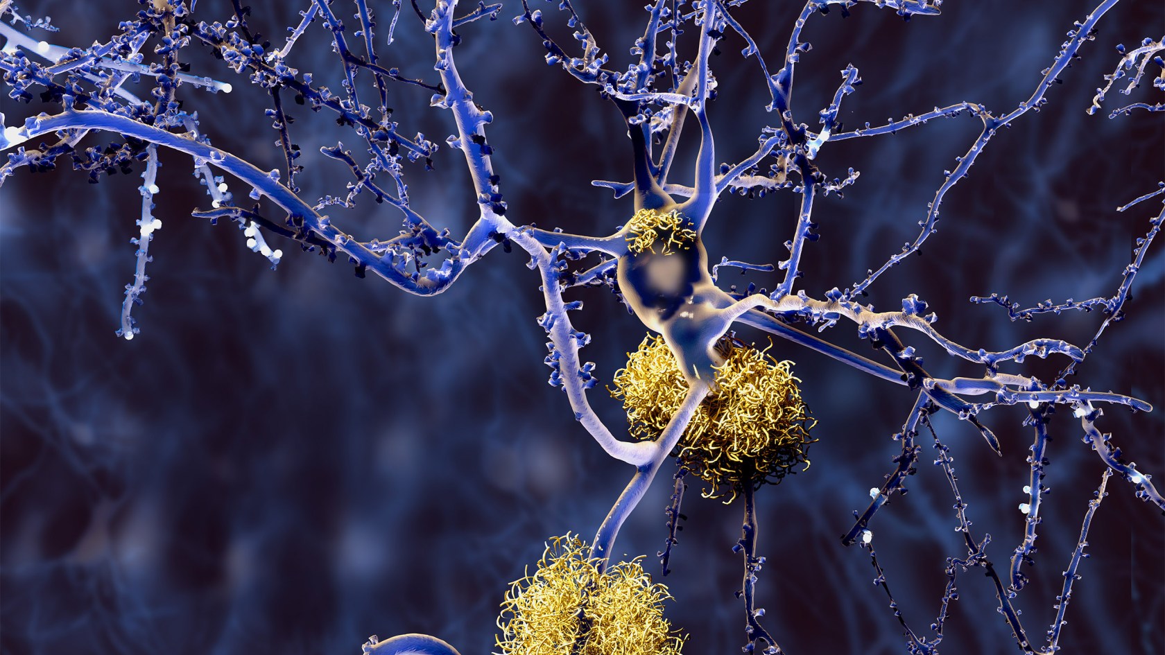 This illustration shows neurons with amyloid plaques, a hallmark of Alzheimer’s disease, in yellow.