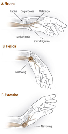 Image (1) 31-carpal-1.jpg for post 8998 – Harvard Gazette