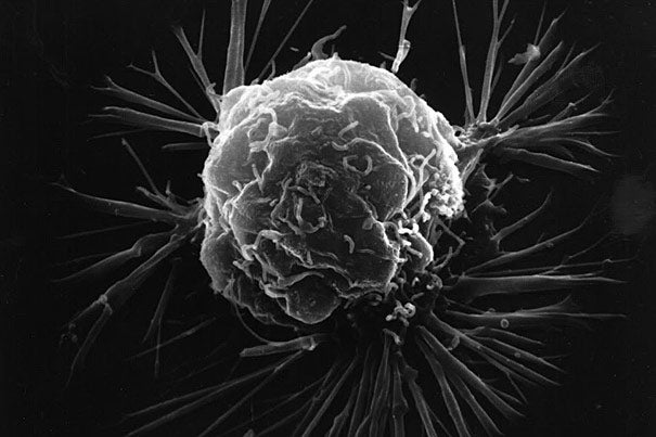 Triple-negative breast cancer is an aggressive disease with few therapeutic options. Patients with such tumors can be treated only with chemotherapy. If the cancer spreads, the median survival rate is one year. Pictured is a breast cancer cell. 
