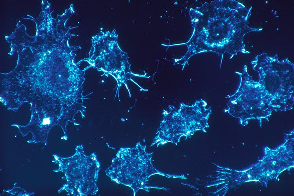 Shown are cancer cells in culture from human connective tissue. Cancer cells survive, in part, by ignoring signals to become senescent and continuing to make copies of themselves at will, or by entering a quiescent state from which they can be re-activated. 