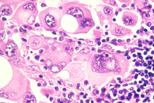 Pictured are human metastatic melanoma cells. A duo of drugs, each targeting a prime survival strategy of tumors, can be safely administered and is potentially more effective than either drug alone for advanced, inoperable melanomas, according to a phase 1 clinical trial led by Harvard investigators at the Dana-Farber Cancer Institute. Image source: Lance Liotta Laboratory
