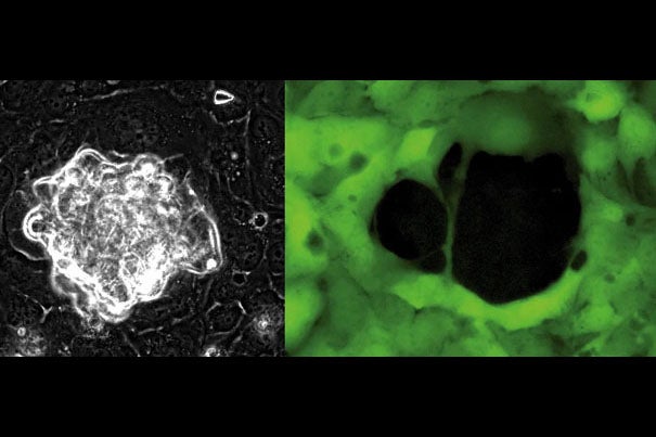 Ovarian cancer cells (left), in white, use physical force to push their way through a layer of mesothelial cells. The mesothelial cells (right), labeled green, are left with a gaping hole, the result of the bullying cancer cells.