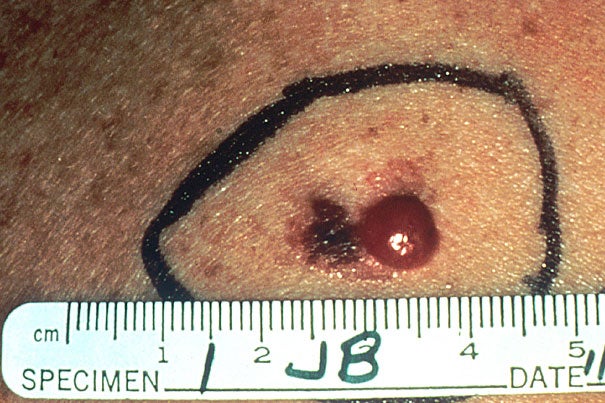 "Early-stage melanomas are often cured by surgical removal, but in about 10 percent of patients who undergo surgery and are considered cancer-free, the disease recurs in metastatic form and becomes fatal," says Lynda Chin, a Harvard Medical School professor. "The goal of this study was to see if we could find genetic events within the tumor cells that indicate which patients are at high risk for metastasis." Pictured is advanced malignant melanoma.	