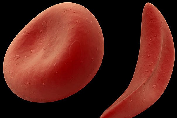 First described more than 100 years ago, sickle cell disease (or sickle cell anemia) is an inherited blood ailment caused by a single mutation in one of the components of hemoglobin, the oxygen-carrying protein in red blood cells. The mutation reduces the protein’s ability to carry oxygen, and forces the cells to curve into a distinctive crescent or sickle shape, causing them to accumulate painfully and break apart in small blood vessels. 