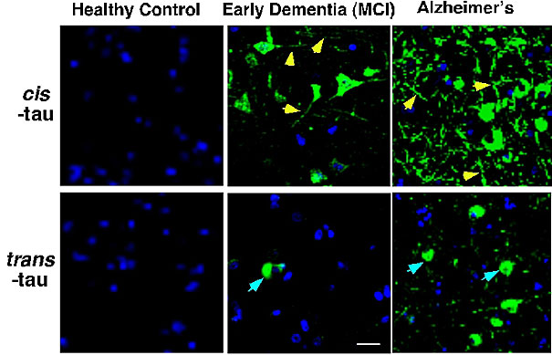 The development of new Alzheimer’s antibodies has made it possible to distinguish between two forms of tau protein, and has demonstrated that the pathological cis form appears in the brain cells of patients with early dementia and, as dementia progresses to Alzheimer’s, rapidly accumulates at the location that is critical for memory (as indicated by arrows).