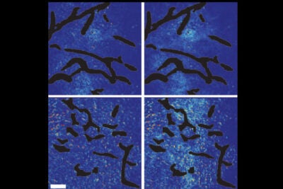 A new study shows that combining angiogenesis inhibitors and nanomedicines only improves cancer treatment when the nanomedicines are at the small end of a size range. Top panels show the control setups. Bottom panels show mammary tumor tissue after normalization of blood vessels. Few of the large nanoparticles are visible in the bottom left panel, while the smaller nanoparticles have penetrated well, as seen in the bottom right panel. 