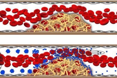 The shear-activated nanotherapeutic breaks apart and releases its drug when it encounters regions of vascular narrowing.

