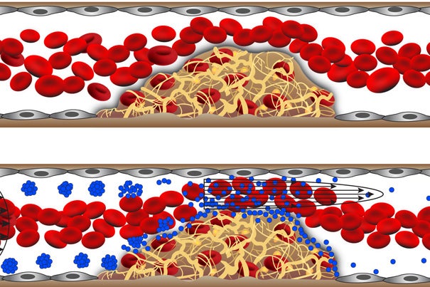 The shear-activated nanotherapeutic breaks apart and releases its drug when it encounters regions of vascular narrowing.

