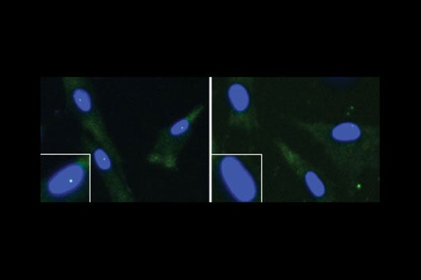 These are fibroblasts from an unaffected individual (left) and an ALS patient with a FUS mutation. The cell nucleus is shown in blue and the "gems" are the green dots within the nuclei. The nuclei in the white boxes are magnified. 