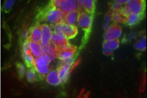 Breast cancer specimens reveal that the LOX gene plays an underlying role in promoting metastasis. “We don’t have a lot of therapies that can target breast cancer once it has metastasized, particularly once cancer cells have lodged in the bone,” says senior author Antoine Karnoub, an assistant professor of pathology at Harvard Medical School. 