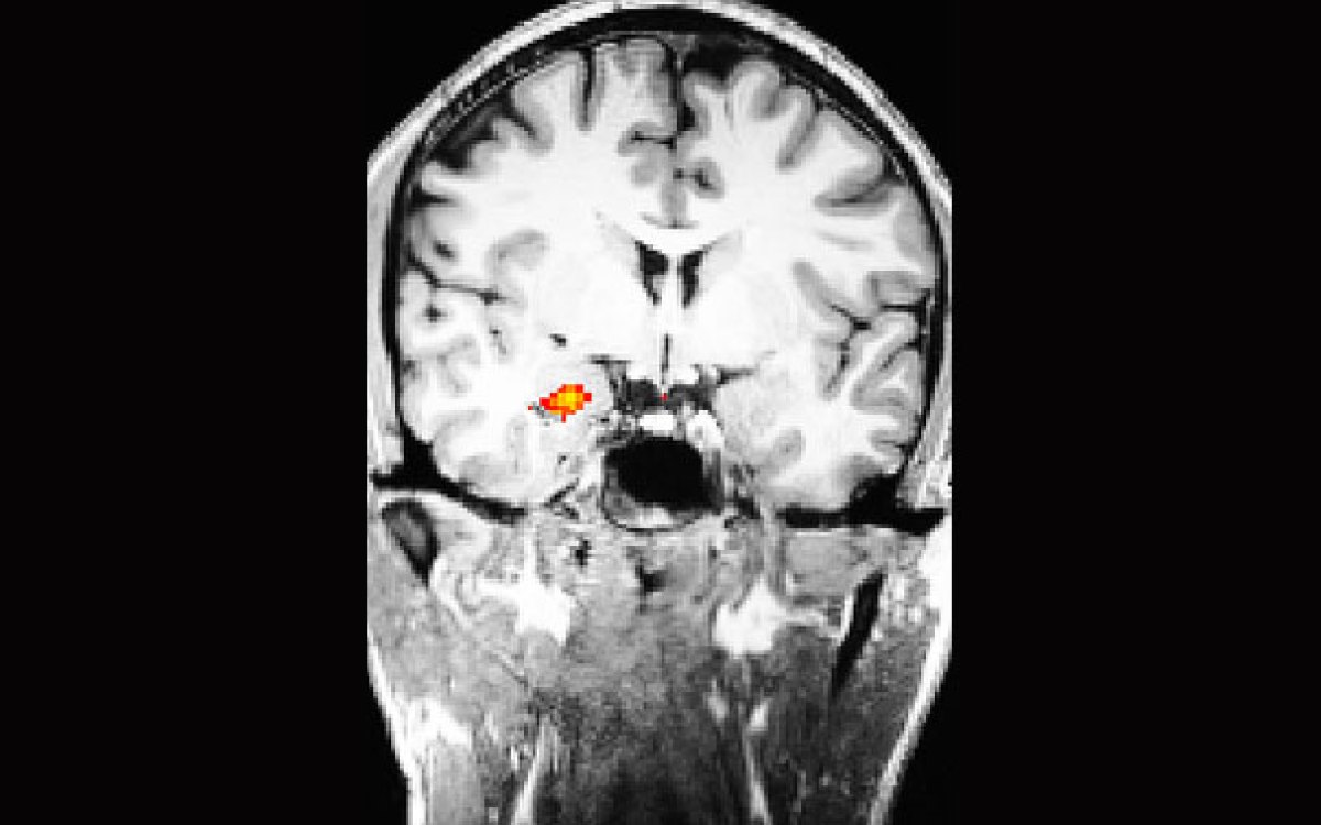 case study anxiety and depression