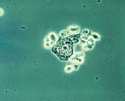 Researchers have found that the pathogenicity of the sexually transmitted protozoan parasite Trichomonas vaginalis — the cause of trichomoniasis — is fueled by a viral invader. Pictured is the Trichomonas vaginalis trophozoite.