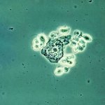 Researchers have found that the pathogenicity of the sexually transmitted protozoan parasite Trichomonas vaginalis — the cause of trichomoniasis — is fueled by a viral invader. Pictured is the Trichomonas vaginalis trophozoite.