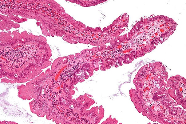 A pre-malignant lesion of the colon, which can be a precursor of colorectal cancer. A Harvard study has shown that 40 percent of all colorectal cancers might be prevented if people underwent regular colonoscopy screening. 
