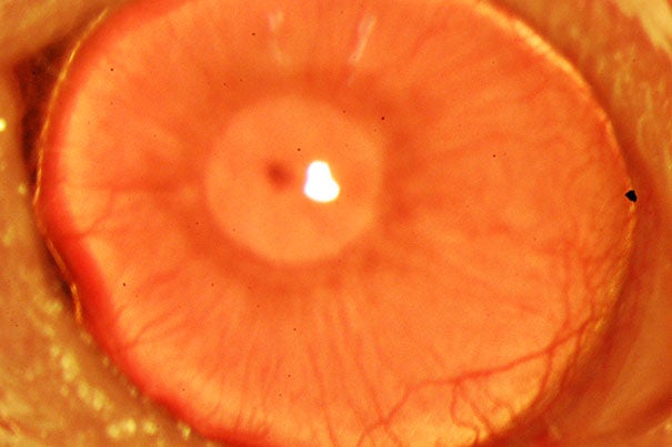A restored functional cornea (photo 1). The  composite image (photo 2) shows the process. In this study, researchers were able to use antibodies detecting the marker molecule to zero in on the stem cells in tissue from deceased human donors and use it to regrow anatomically correct, fully functional human corneas in mice. 