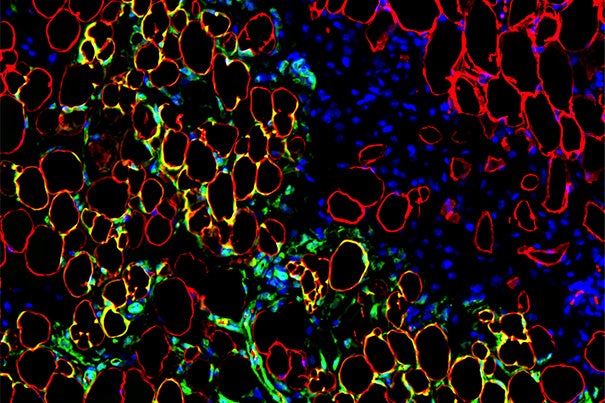 Fat cells (yellow) descended from transplanted human mesenchymal stem cells (green) inside of a mouse 28 days after a co-transplantation procedure. The red stain shows mouse fat cells. The blue stain shows cell nuclei. 
