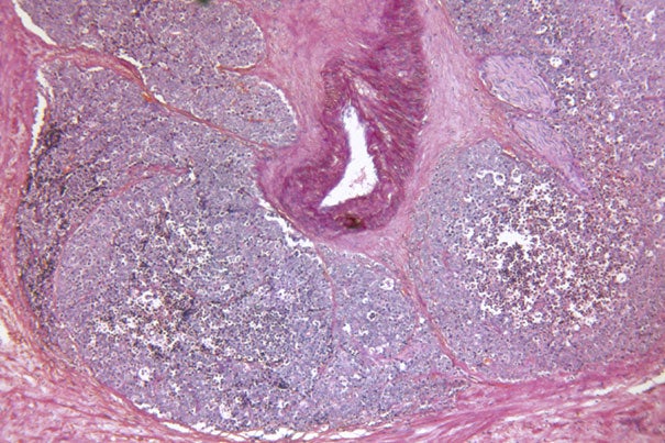 “This study follows our initial publication on vasectomy and prostate cancer in 1993, with 19 additional years of follow-up and tenfold greater number of cases. The results support the hypothesis that vasectomy is associated with an increased risk of advanced or lethal prostate cancer,” said co-author Lorelei Mucci, associate professor of epidemiology at Harvard School of Public Health.