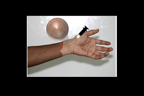 In a depiction of a hand transplant, researchers illustrate how injecting a hydrogel-drug combination beneath the skin results in the controlled release of immunosuppressant drugs to prevent rejection of the transplanted limb. 