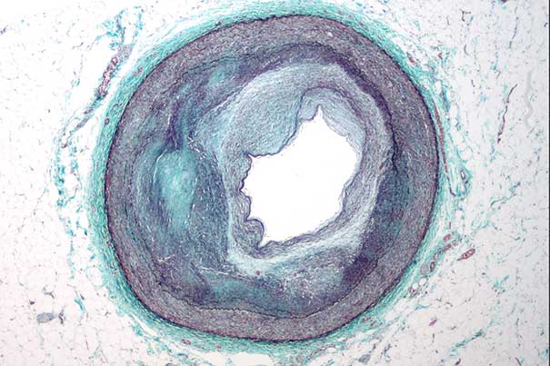 Pictured is a micrograph of an artery that supplies the heart showing significant atherosclerosis and marked luminal narrowing. Researchers have found a way to discourage inflammatory cells from changing the artery's surface, which attracts the build-up of plaque, leading to heart attacks, strokes, and other inflammatory diseases.