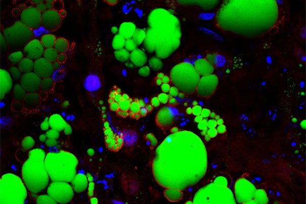 Harvard researchers have created a system using human stem cells to screen for compounds that have the potential to turn white, or “bad,” fat cells into brown, or “good,” fat cells.
Pictured are human pluripotent stem cell-derived fat cells.