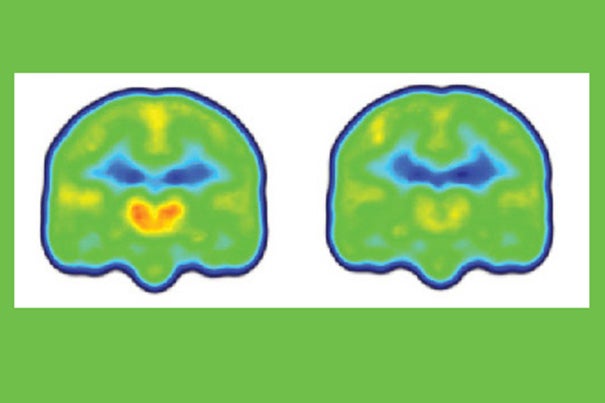 Images created by averaging PET scan data from chronic pain patients (left) and healthy controls (right) reveals higher levels of inflammation-associated translocator protein (orange/red) in the thalamus and other brain regions of chronic pain patients.