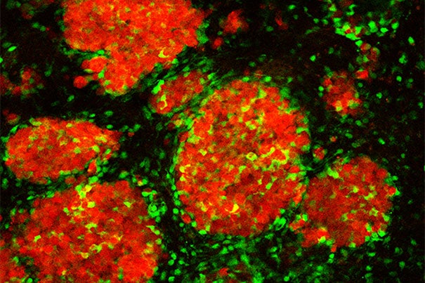 Tagged therapeutic stem cells (green) targeting breast cancer metastases (red) in the brain of a mouse model.