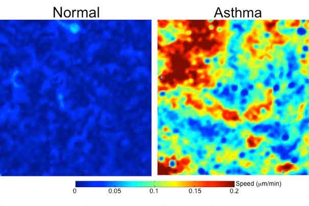 The images show human bronchial epithelial cells obtained from a normal donor (left) and an asthmatic donor. The color-coded bar reflects the speed at which the cells move.