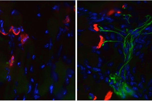 In the right-hand picture, an SMA mouse treated with guanabenz, a compound known to reduce cellular stress, shows healthy junctions between muscle cells (red) and motor nerve fibers (green). In contrast, the untreated SMA mouse (left) has lost its nerve fibers, leaving the muscle cells with no way to receive signals from neurons in the spinal cord.