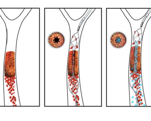 The novel drug-device combination developed by a team from Harvard’s Wyss Institute and the New England Center for Stroke Research works quickly to re-vascularize a vessel obstructed by a blood clot. In this schematic, the re-vascularization process is depicted from left to right. An intra-arterial stent is used to open a small channel in the blood clot, restoring enough blood flow to trigger the clot-busting nanotherapeutic, which is activated by physical cues of fluid shear force. 