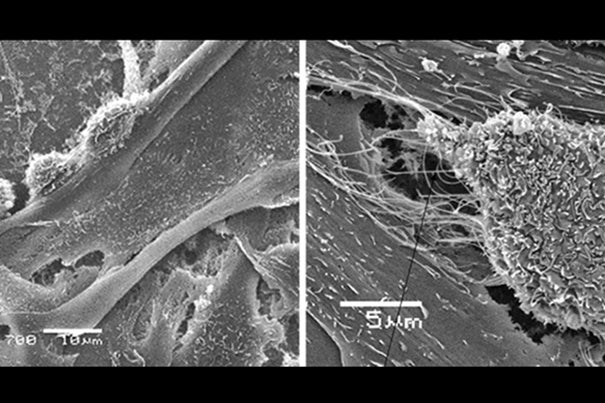 Cancer cells invading a blood vessel as seen on the left. In the image on the right, metastatic cancer cell form nanoscale bridges with endothelial cells lining blood vessels and inject miRNA through these nanobridges to control the endothelial cells. 
