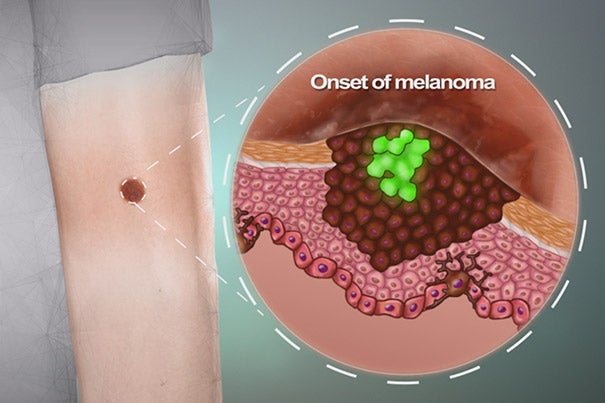 Most of the time skin moles are harmless, but they occasionally turn into melanoma, a life-threatening skin cancer. Leonard Zon and colleagues found that this happens when a single cell regresses back to a stem cell state and starts to divide and invade the surrounding tissue. 