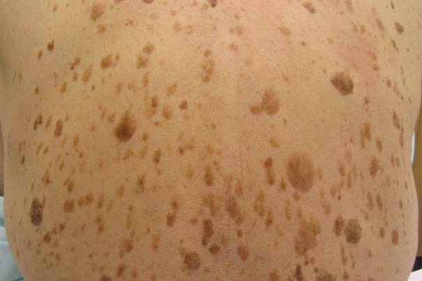 Massachusetts General Hospital researchers are working on a topical treatment that may be available for those with seborrheic keratosis (SK), or liver spots.