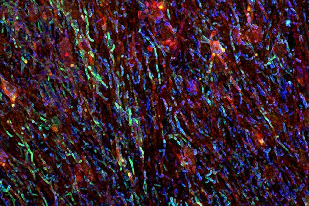 A link between deficits in gut flora and brain inflammation may lead researchers to learn more about its impact on multiple sclerosis. Pictured is immunofluorescence imaging of an active lesion in the brain of an individual with MS.