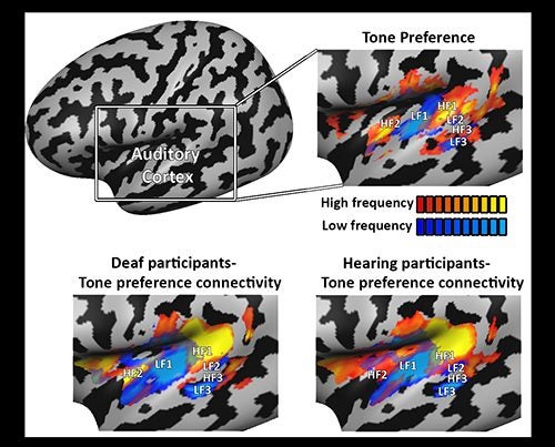 Mapping tone-preference connectivity patterns in deaf people shows the auditory cortex develops even without sounds. The connectivity profile was virtually identical to that of hearing people, suggesting it develops based on genetic and innate constraints, not on experience.
