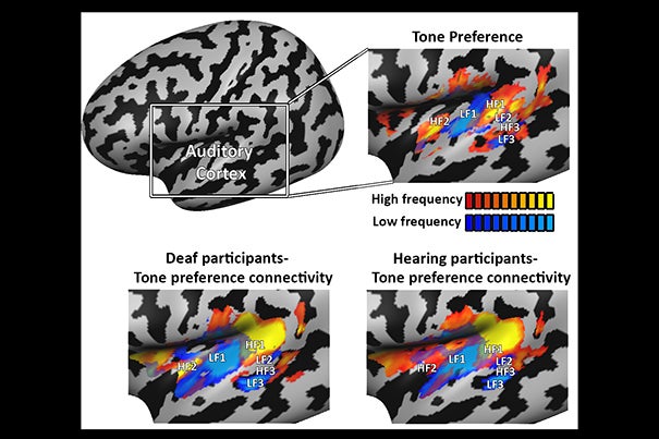 Mapping tone-preference connectivity patterns in deaf people shows the auditory cortex develops even without sounds. The connectivity profile was virtually identical to that of hearing people, suggesting it develops based on genetic and innate constraints, not on experience.
