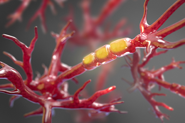 Therapies already in development aim to block the activity of a particular enzyme in order to halt the stripping of axons and prevent neuronal dysfunction in people with amyotrophic lateral sclerosis, or ALS.