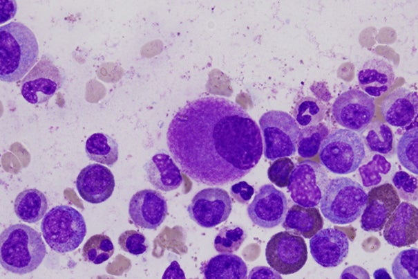 Researchers discovered that chronic myelogenous leukemia stem cells die in response to inhibition of a protein called Ezh2. Drugs that target the protein are currently being tested in clinical trials for other cancers.