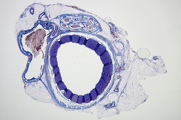 Histological staining of an untreated vessel where blood can freely flow (image 1) and a vessel (image 2) that was successfully filled and embolized with the shear-thinning biomaterial (STB). Over time, the STB was degraded and replaced by natural tissue in with only remnants of the STB (indicated by asterisks). Credit: Wyss Institute at Harvard University
