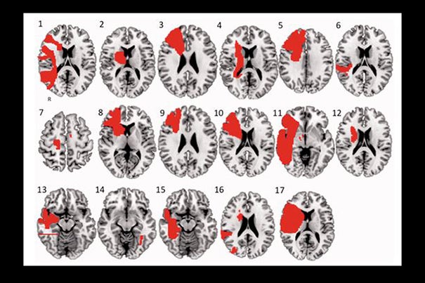 Each lesion, numbered 1 through 17, was identified from a literature search or from cases seen by the authors and manually traced onto a common brain atlas. Image by Emily Barrett/BIDMC