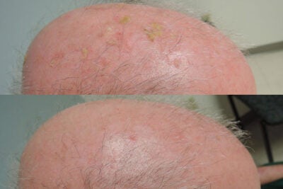 Actinic keratosis lesions (top image), the yellowish patches, were treated with a combination of calcipotriol plus fluorouracil. Within eight weeks they had largely disappeared (below).