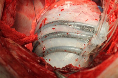 The soft robotic sleeve twists and compresses in synch with a beating heart, augmenting cardiovascular functions weakened by heart failure. Unlike currently available devices that assist heart function, Harvard’s soft robotic sleeve does not directly contact blood. 