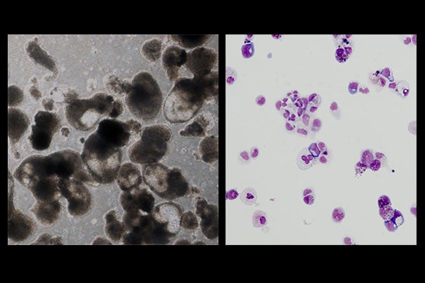 Red blood cells successfully made via induced pluripotent stem cells from a Diamond-Blackfan anemia (DBA) patient. Control iPS cells (left) and DBA iPSc cells (right), showing that DBA blood cells don’t mature properly. 
