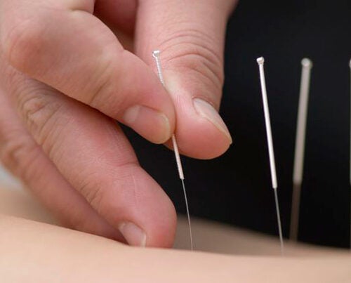 Research indicates that "real" acupuncture rewires the brain to produce long-term improvement in carpal tunnel syndrome symptoms, while "sham" acupuncture may produce temporary results by tapping into the placebo circuitry in the brain.