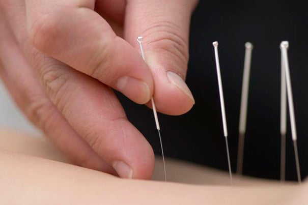 Research indicates that "real" acupuncture rewires the brain to produce long-term improvement in carpal tunnel syndrome symptoms, while "sham" acupuncture may produce temporary results by tapping into the placebo circuitry in the brain.